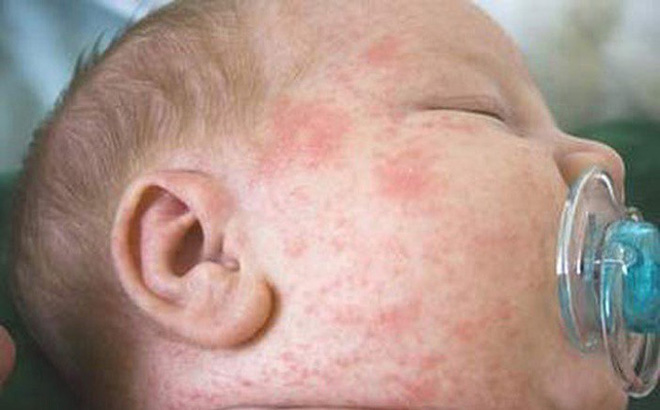 Triệu chứng bệnh sởi: 3 dấu hiệu sớm, phân biệt sởi với sốt phát ban