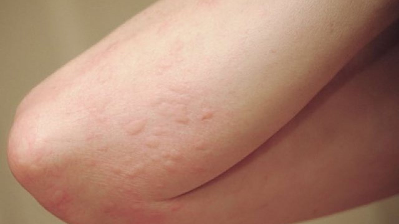 Bệnh dị ứng da gây ra do đâu và có gây ra nguy hiểm gì không?