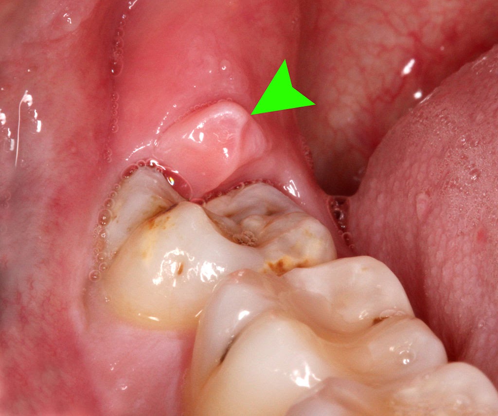 Viêm nhiễm do mọc răng số 8