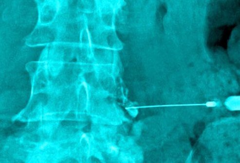 Chụp X-quang tiêm hydrocortisone ở cột sống.