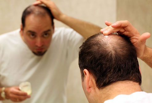 Minoxidil có thể giúp làm chậm tốc độ rụng tóc, nhưng bạn phải sử dụng sản phẩm liên tục.