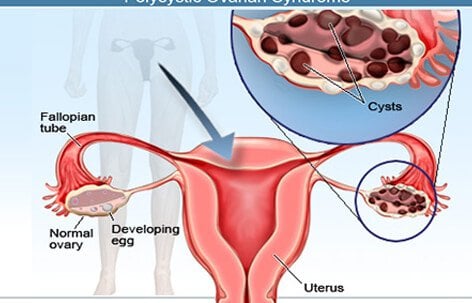 Loại u nang buồng trứng phổ biến nhất được gọi là u nang cơ năng.