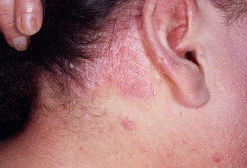 Bệnh vẩy nến thường xảy ra trên da đầu, có thể gây ra vảy da mịn hoặc các vùng mảng bám đóng vảy nhiều. 