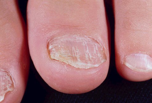 Trong một số trường hợp, bệnh vẩy nến có thể chỉ liên quan đến móng tay và móng chân, mặc dù phổ biến hơn, các triệu chứng ở móng tay sẽ đi kèm với các triệu chứng bệnh vẩy nến và viêm khớp.