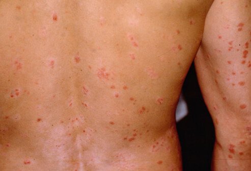 Bệnh vẩy nến gây ra các giọt nhỏ màu hồng cá hồi trên da là bệnh vẩy nến guttate, ảnh hưởng đến khoảng 10% những người bị bệnh vẩy nến.