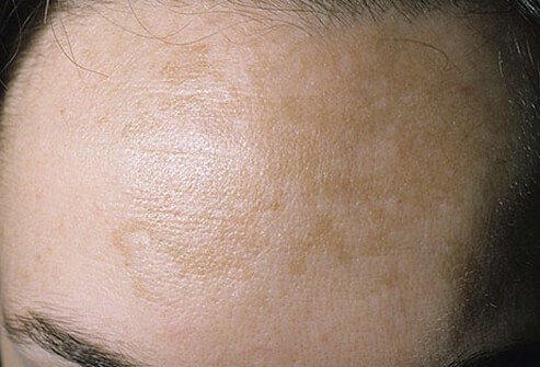 Nám da (chloasma) là một mảng da nâu bất thường trên má, mũi hoặc trán, thường phát triển trong thời kỳ mang thai.