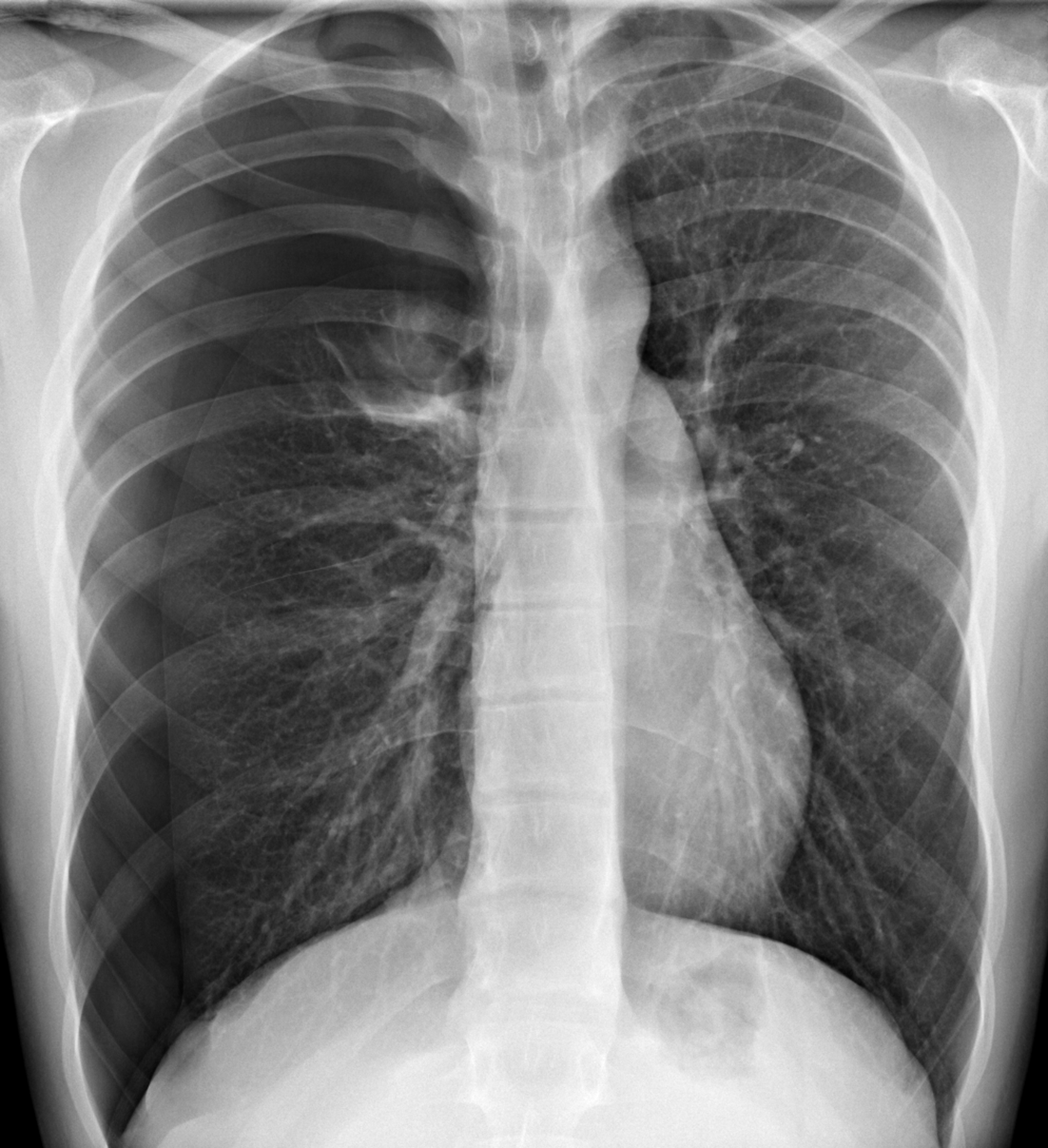 Tràn khí màng phổi - Rối loạn chức năng hô hấp - Cẩm nang MSD - Phiên bản dành cho chuyên gia