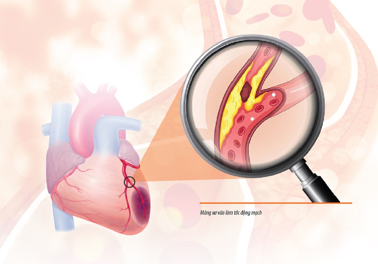 Tắc động mạch vành: Nguyên nhân và mức độ nguy hiểm | TCI Hospital