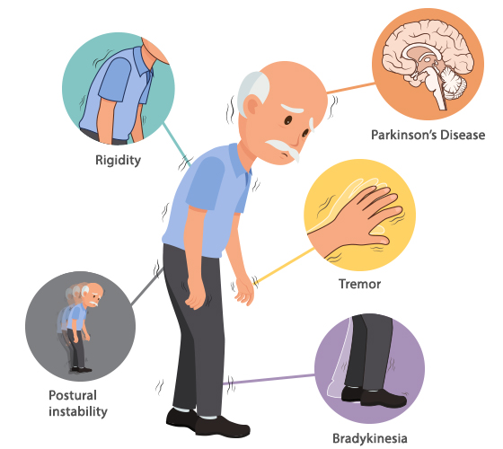 Triệu chứng Parkinson thường gặp